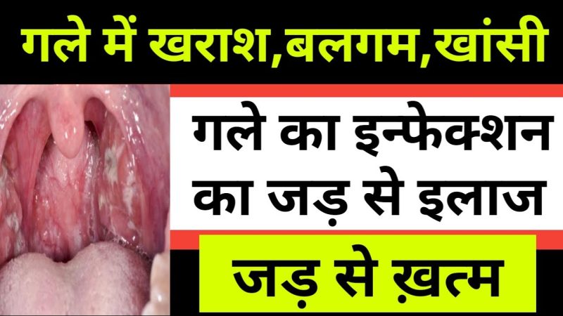 गले में खराश के लक्षण  Symptoms of Sore Throat