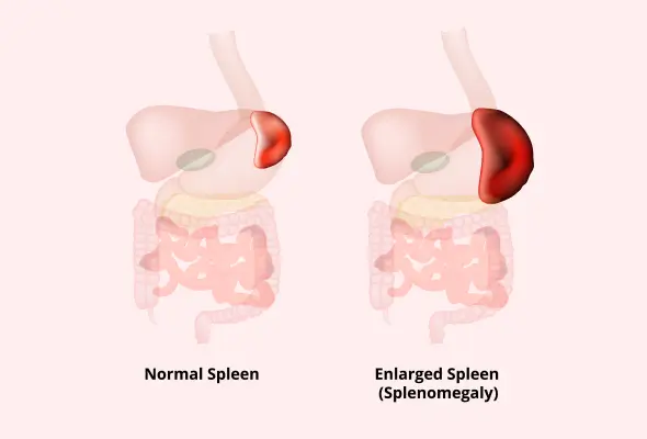 प्लीहा के रोग और स्वास्थ्य समस्याएं (Spleen Diseases and Health Problems)  कारण, लक्षण और उपचार