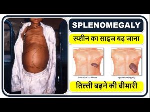 splenomegaly meaning in hindi 2