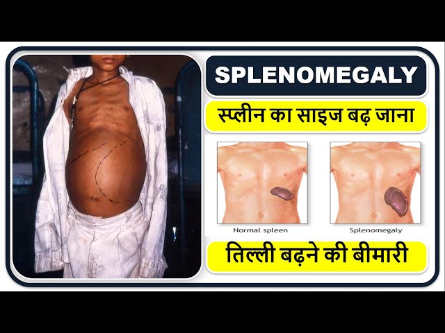 Splenomegaly Meaning In Hindi: प्लीहा का बढ़ना, कारण, लक्षण और उपचार 9 स्प्लेनोमेगाली के सामान्य कारण: हिंदी में विस्तृत जानकारी