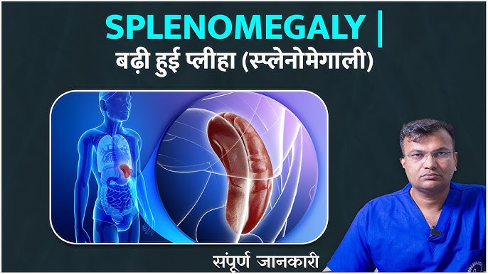 Splenomegaly Meaning In Hindi: प्लीहा का बढ़ना, कारण, लक्षण और उपचार 10 स्प्लेनोमेगाली के लक्षण: हिंदी में पहचान और समझ