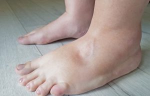 swelling meaning in hindi 1 1