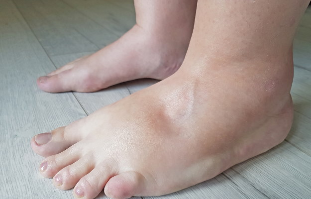 सूजन क्या है? (What is Swelling?)