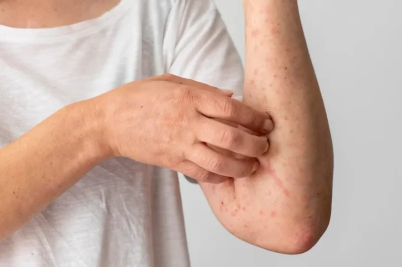 सिफिलिस के कारण और जोखिम कारक (Syphilis ke karan aur jokhim karak)  सिफिलिस के कारणों और जोखिम कारकों को समझें ताकि आप इसे रोकने के लिए कदम उठा सकें।