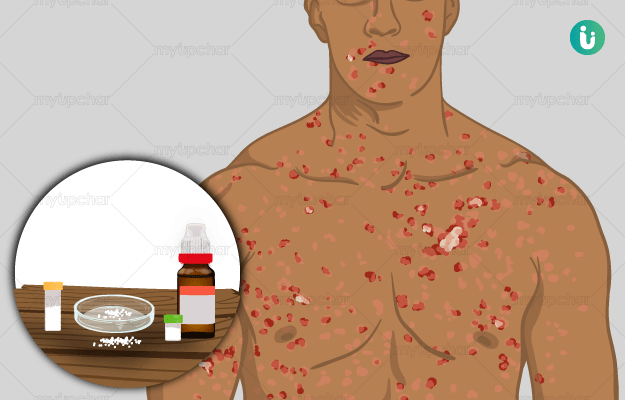 सिफिलिस का उपचार: एंटीबायोटिक्स और अन्य विकल्प (Syphilis ka upchar: antibiotics aur anya vikalp)  सिफिलिस का इलाज एंटीबायोटिक्स से किया जा सकता है। हम आपको उपचार के विकल्पों के बारे में जानकारी देंगे।