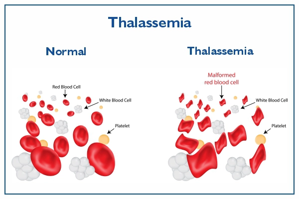 थैलेसीमिया के लक्षण और संकेत (Thalassemia Ke Lakshan Aur Sanket)