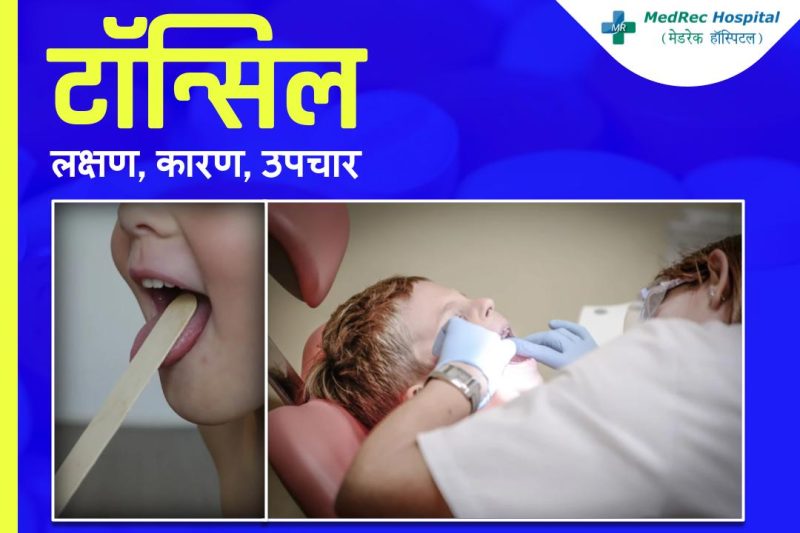 टॉन्सिल के प्रकार: हिंदी स्पष्टीकरण के साथ  विभिन्न प्रकार के टॉन्सिल (जैसे कि पैलेटिन, लिंगुअल, एडेनोइड) और उनके कार्यों को हिंदी में जानें।