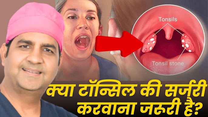 टॉन्सिल से संबंधित सामान्य समस्याएं और हिंदी में उनके समाधान  टॉन्सिल के बढ़ने, टॉन्सिल स्टोन (टॉन्सिल पर पथरी) और अन्य संबंधित समस्याओं के बारे में जानें, साथ ही उनके हिंदी में समाधान भी जानें।
