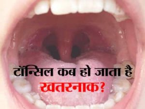 tonsils meaning in hindi 1
