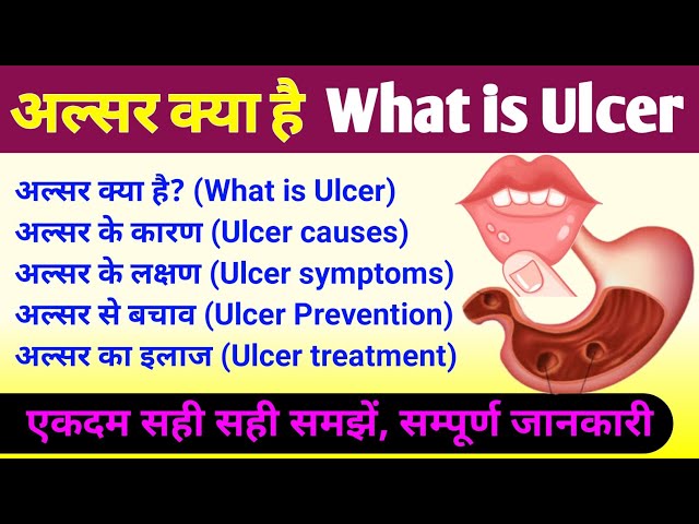 अल्सर का हिंदी में अर्थ: परिभाषा, प्रकार और कारण