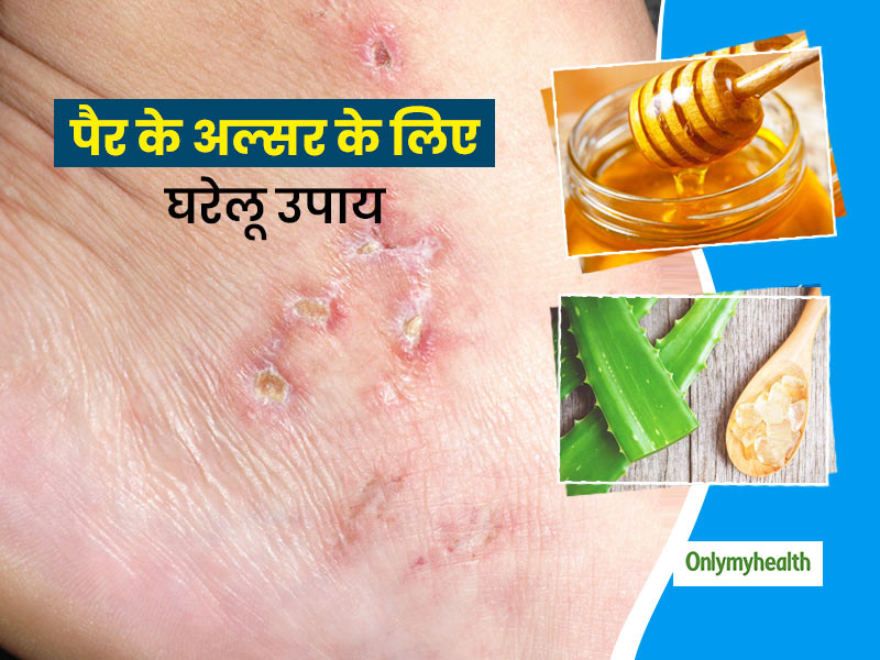 अल्सर के घरेलू उपचार और बचाव