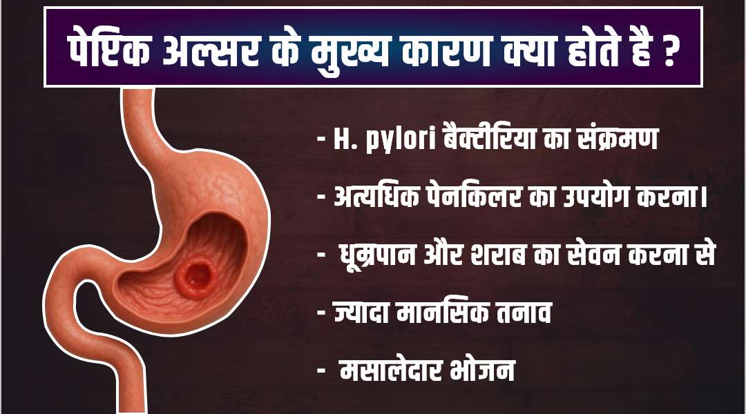 अल्सर के प्रमुख प्रकार और उनके लक्षण
