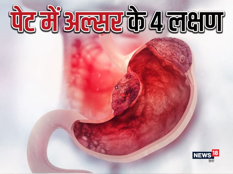 अल्सर के सामान्य लक्षण और संकेत