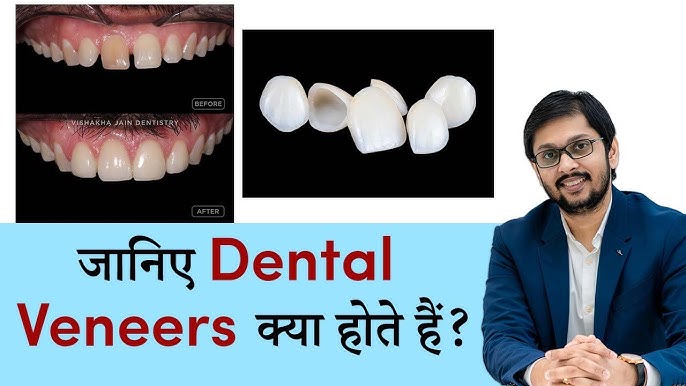 veneer meaning in hindi - Hình 4