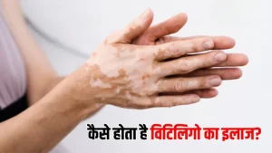vitiligo meaning in hindi 1