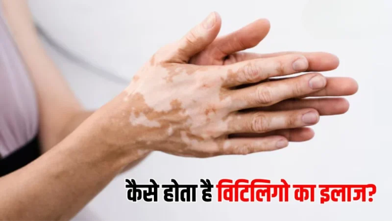 विटिलिगो के लक्षण: पहचानें और समझें (Vitiligo ke lakshan: Pahchane aur samjhe)