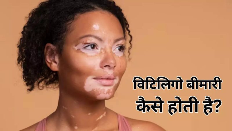 विटिलिगो के कारण: क्या हैं और कैसे बचें? (Vitiligo ke karan: Kya hain aur kaise bachen?)