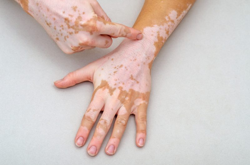 विटिलिगो के प्रकार: सामान्य और विशिष्ट (Vitiligo ke prakar: Samanya aur vishisht)