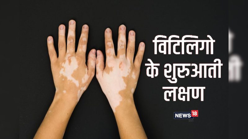विटिलिगो का निदान: परीक्षण और प्रक्रियाएँ (Vitiligo ka nidan: Parikshan aur prakriyaen)