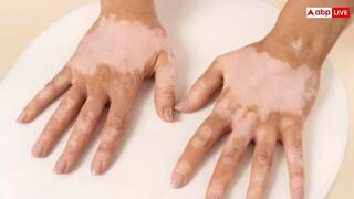 विटिलिगो का उपचार: आधुनिक और पारंपरिक तरीके (Vitiligo ka upchar: Aadhunik aur paramparik tarike)