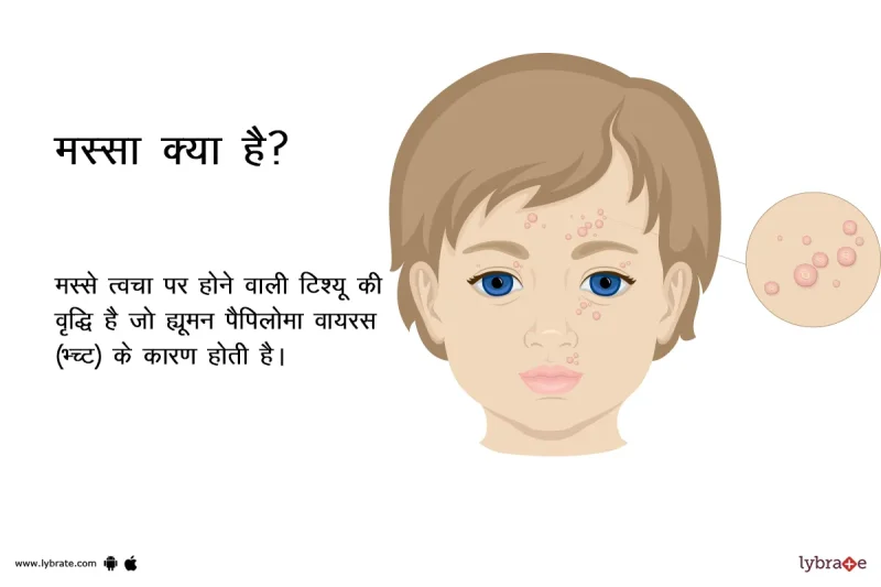 मस्से का मतलब हिंदी में क्या है? (Masse ka matlab hindi mein kya hai?  मस्से की परिभाषा और मूल अर्थ)