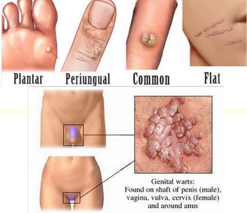 मस्से के प्रकार: सामान्य मस्से, फ्लैट मस्से, और अन्य (Masse ke prakar: Samanya masse, flat masse, aur anya  विभिन्न प्रकार के मस्से और उनकी विशेषताएं)
