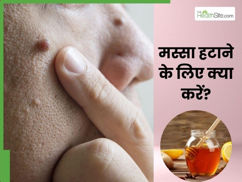 मस्सों का इलाज कैसे किया जाता है? (Masson ka ilaaj kaise kiya jata hai?  मस्सों के विभिन्न उपचार विधियाँ और प्रक्रियाएं)