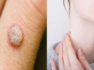 wart meaning in hindi 5