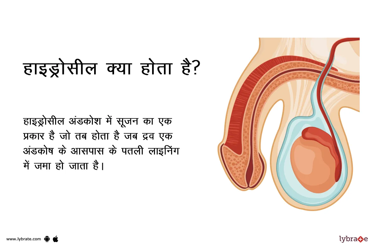 Hydrocele In Hindi Meaning: अंडकोष में पानी भरने के कारण, लक्षण और नवीनतम उपचार